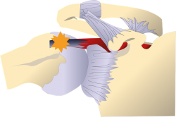 shéma de l'épaule avec le sus-épineux et son mecanisme de tendinite