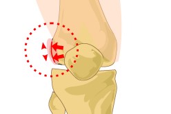 shéma anatomique du tendon du tenseur fascia-lata