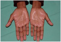 deux mains couverte de transpiration à cause de l'hyperhydrose